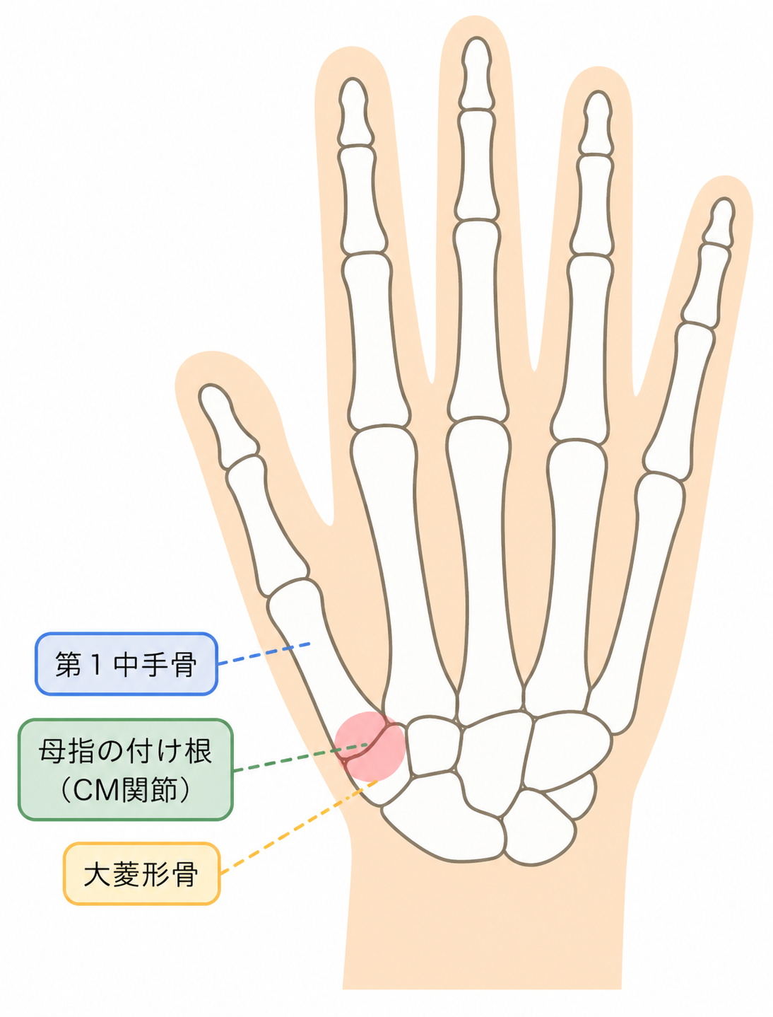 CM関節症