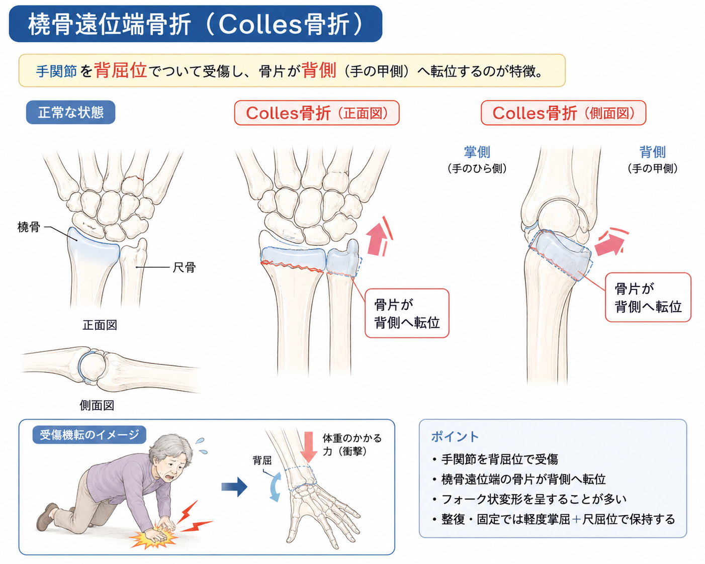 Colles骨折