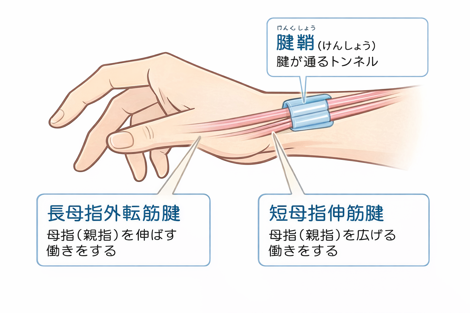 ドゥ・ケルバン腱鞘炎