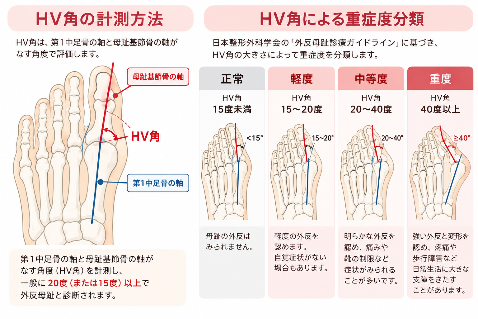 外反母趾角の計測方法