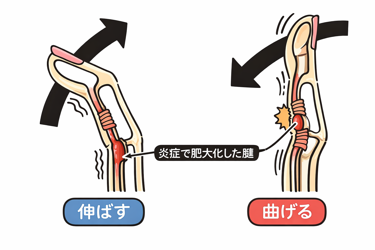ばね指（弾発指）