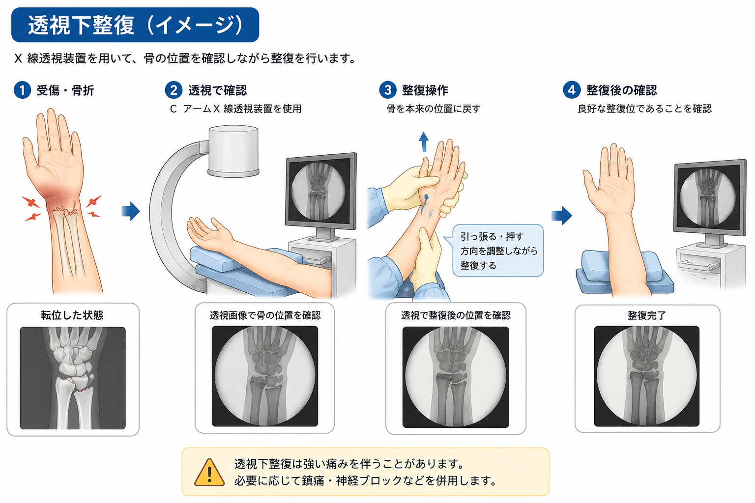透視下整復